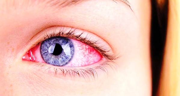 آنتروپیون چیست که زیبایی چشم ها را نابود می کند؟