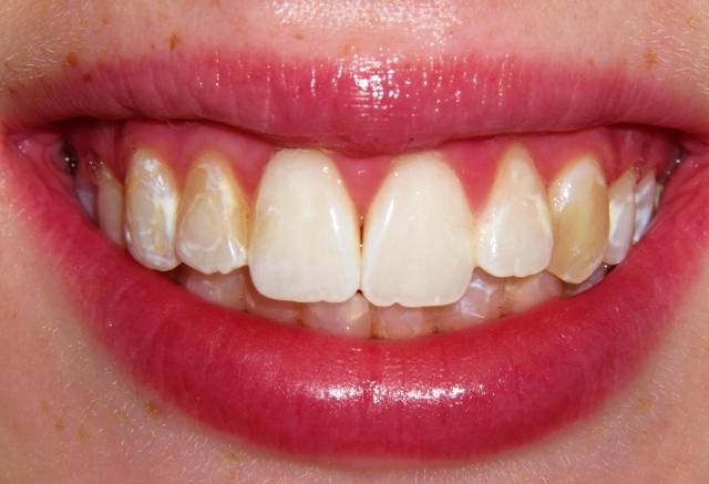 از کجا بفهمیم دندانمان هیپوپلازی مینا دارد؟