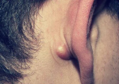 درمان کورک گوش ، جوش های چرکی مزاحم