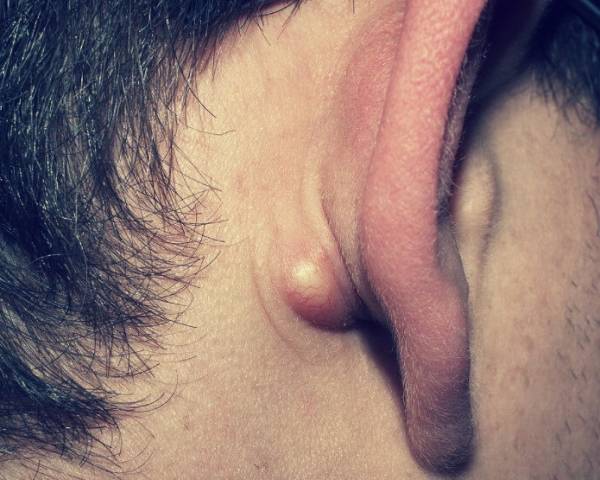 درمان کورک گوش ، جوش های چرکی مزاحم