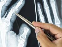 علائم و درمان شکستگی استخوان انگشت دست